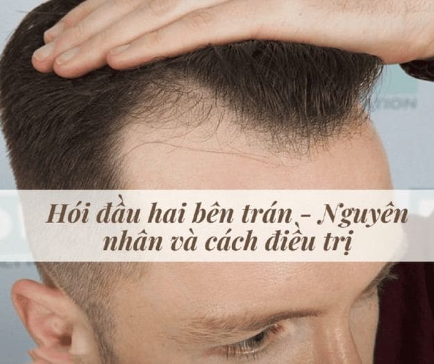 Quy trình cấy tóc và lưu ý khi thiết kế đường chân tóc