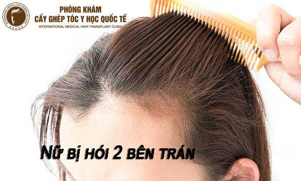 Tại sao mình bị hói ở trán — do di truyền hay do thói quen?
