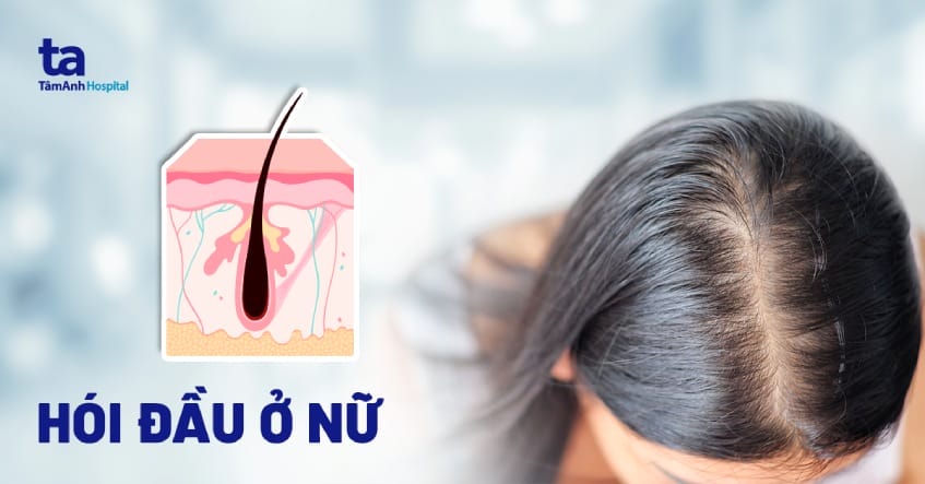 Các phương pháp điều trị nào có bằng chứng cho hói đỉnh ở nữ — thuốc và thủ thuật?
