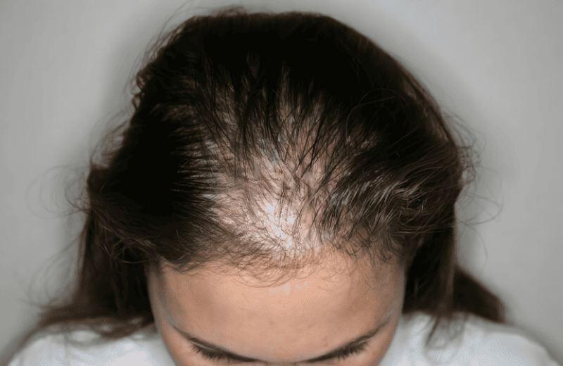 Tại sao nữ giới lại bị hói ở đỉnh đầu — có phải do di truyền?