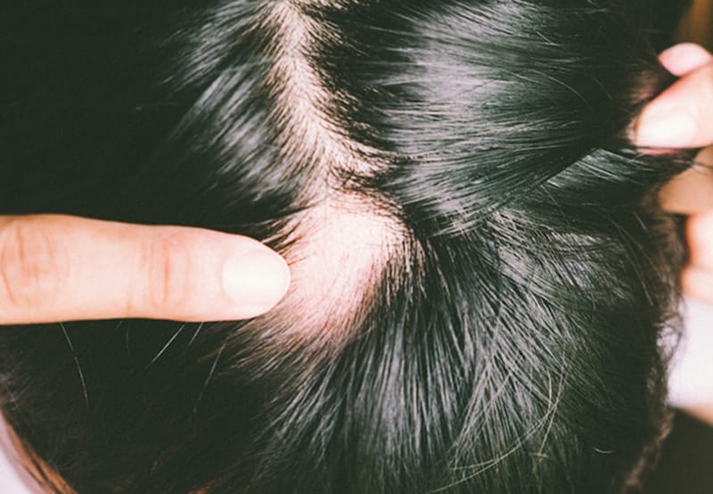 Ngoài alopecia areata, còn những nguyên nhân nào dễ gây rụng từng mảng?