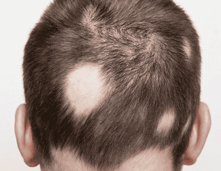 Làm sao để phân biệt và khi nào cần soi da đầu, xét nghiệm?
