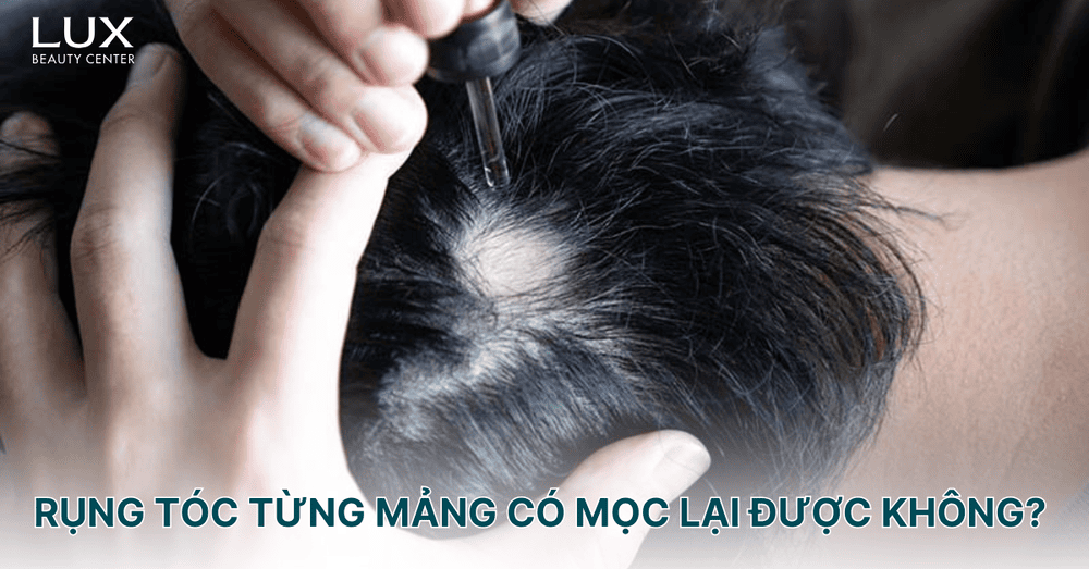 Khi nào cân nhắc dùng JAK inhibitor?
