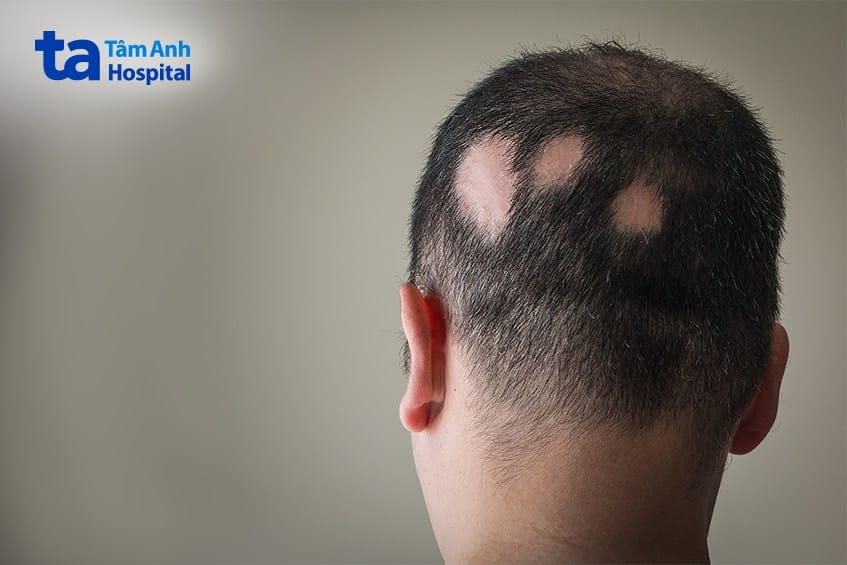 Phác đồ tham khảo và lưu ý đặc biệt trước khi làm thủ thuật