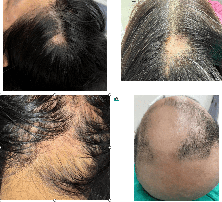 Đó có phải là Alopecia areata (rụng tóc từng mảng) không?