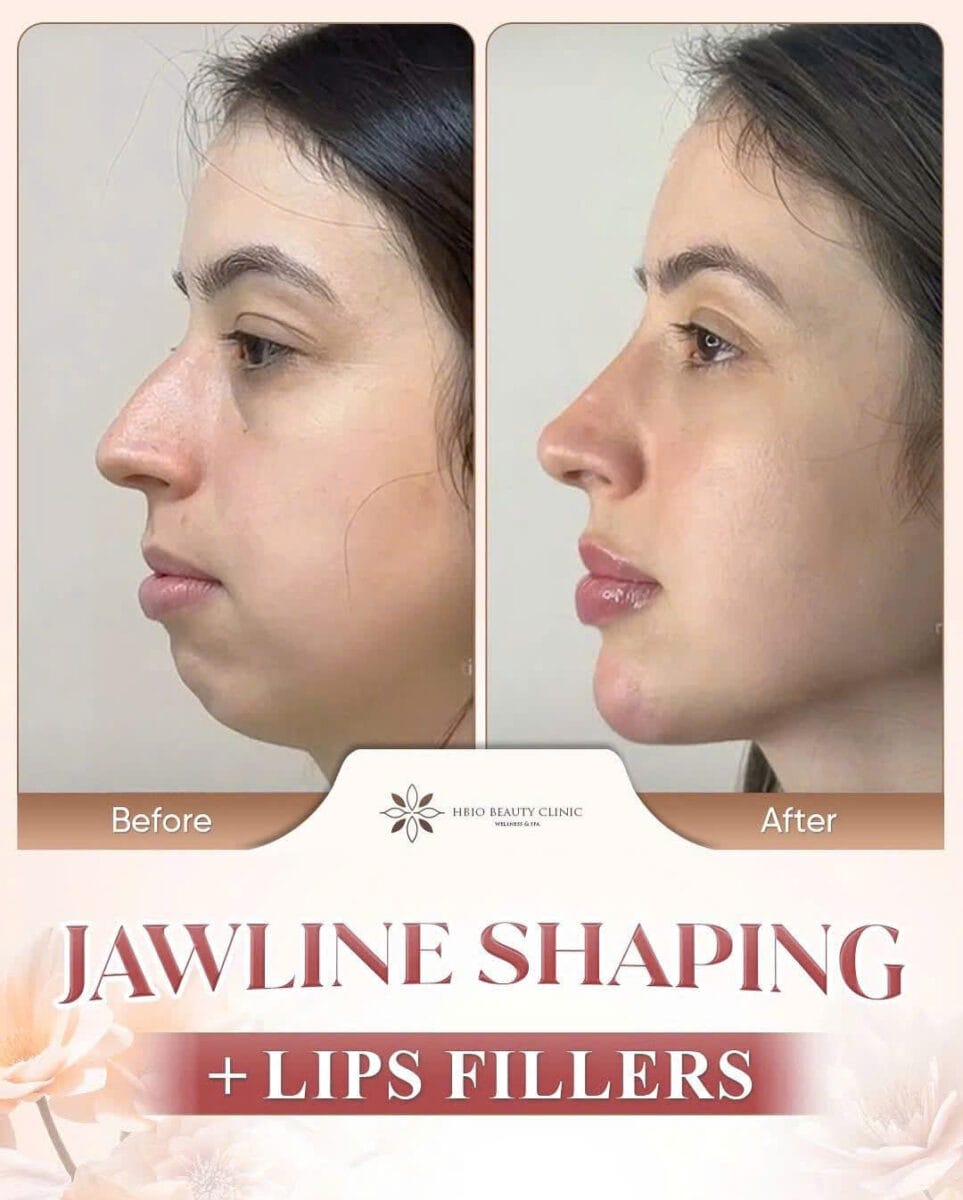 Botox tác động lên cơ nhai như thế nào — Liệu nó có ảnh hưởng đến xoang không?
