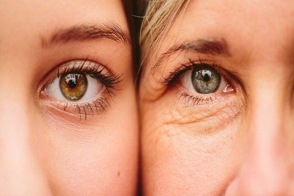 Làm sao phân biệt: nếp nhăn đơn thuần khác gì so với nếp nhăn trên bọng mắt?