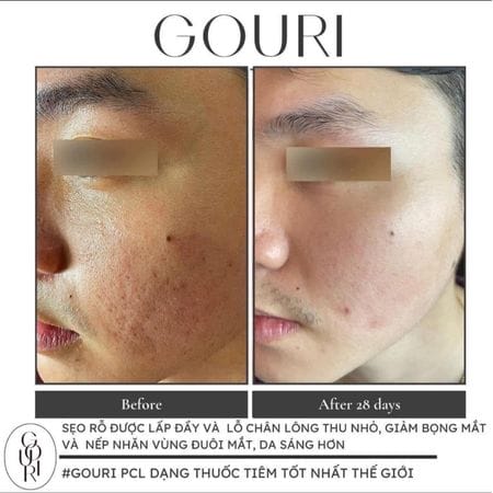 Lộ trình, quy trình và chăm sóc sau tiêm