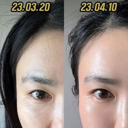 Ai phù hợp và ai không nên tiêm?