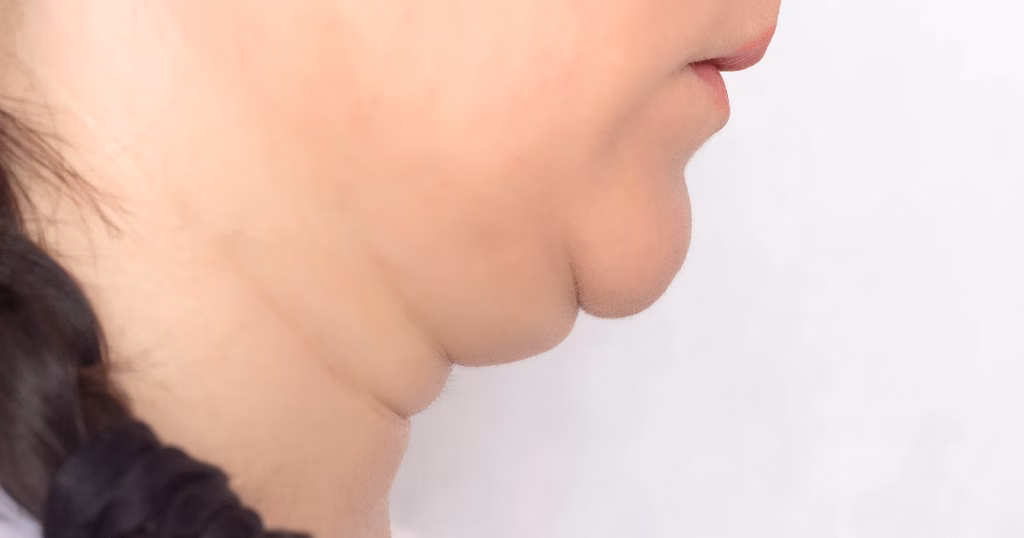 Tiêm tan mỡ cằm (DCA/Kybella): cơ chế tác động, hiệu quả lâm sàng và những điều cần biết?