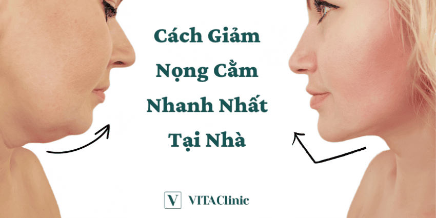Hút mỡ cằm và các phương pháp phẫu thuật: lợi ích, hồi phục và rủi ro?
