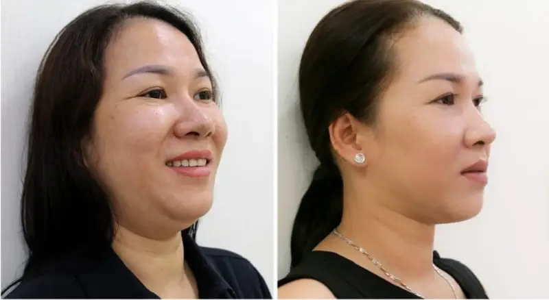 Chu trình thực hiện và chăm sóc sau hút mỡ