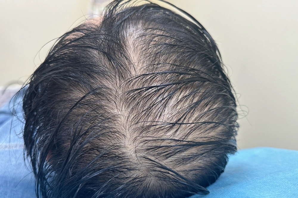 Các lựa chọn điều trị phổ biến — nên chọn thuốc, thủ thuật hay cấy tóc?