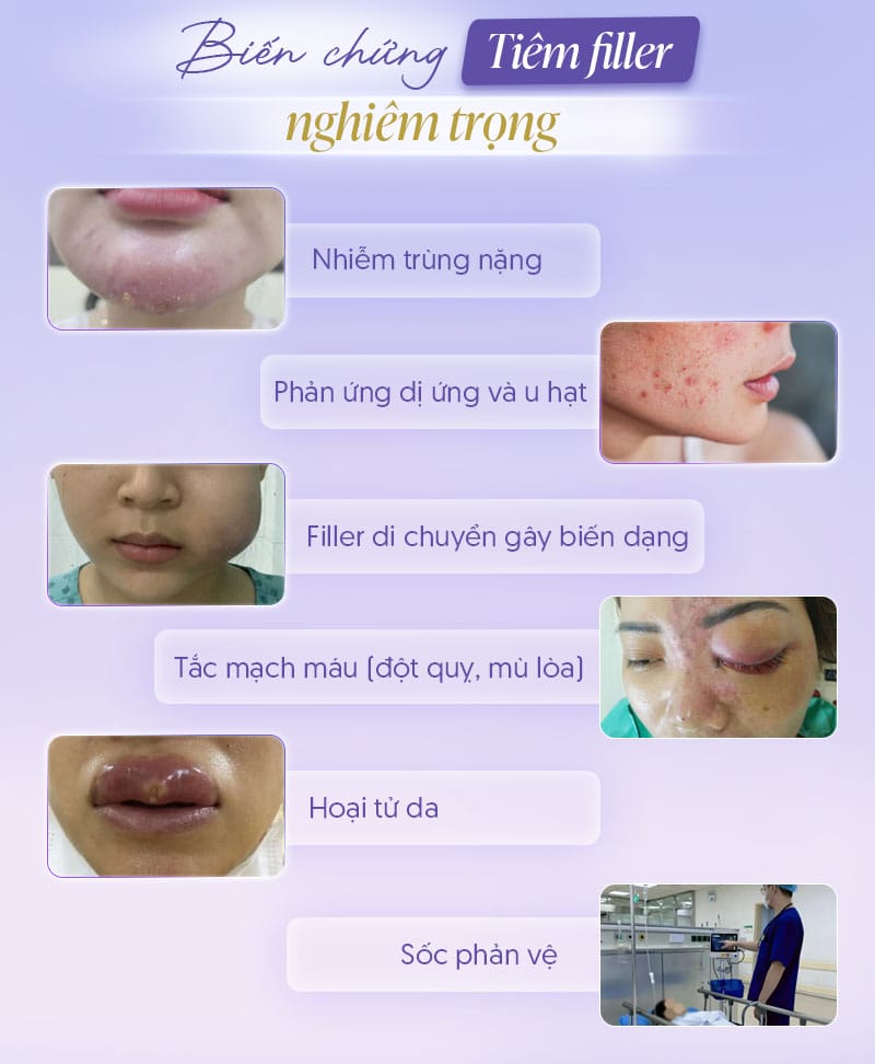 Những biến chứng nào hay gặp sau khi tiêm filler và vì sao chúng xảy ra?