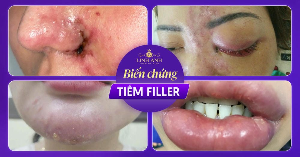 Ai không nên tiêm filler? Chống chỉ định và khi nào nên hoãn điều trị?