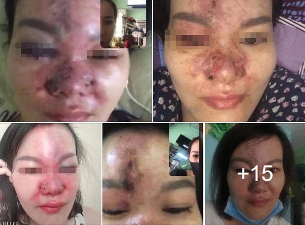 Cơ chế gây tắc mạch, hoại tử và mất thị lực