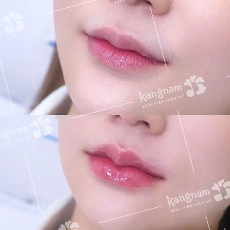 Làm sao để chọn clinic và bác sĩ — đâu là địa chỉ tiêm filler môi an toàn?