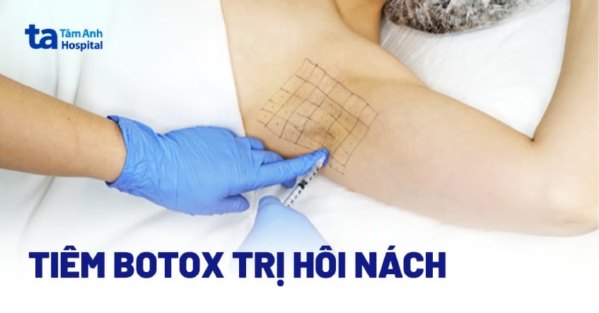 OnabotulinumtoxinA — "Botox" (thường được chứng nhận cho hôi nách)