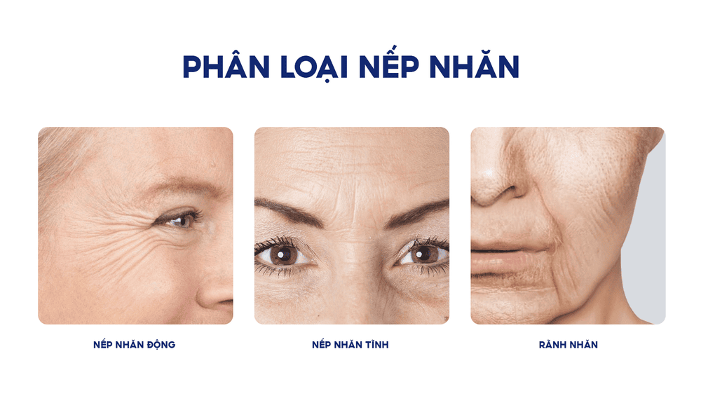 Các phương pháp điều trị nếp nhăn nào hiệu quả — ưu nhược điểm và cơ chế tác dụng?