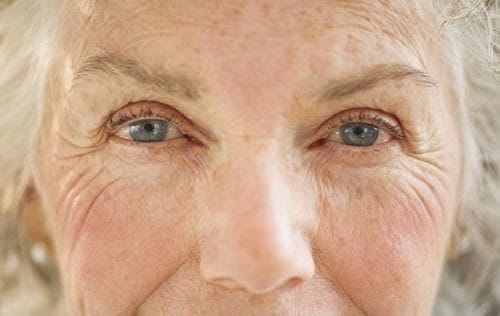 Filler làm đầy (filler hyaluronic acid, biostimulator): phục hồi thể tích hay chỉ xóa rãnh?