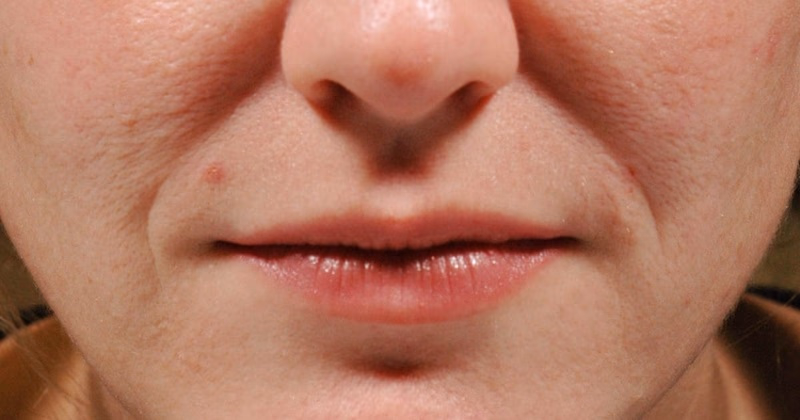 1. Tiêm filler rãnh cười (hyaluronic acid và các loại khác)