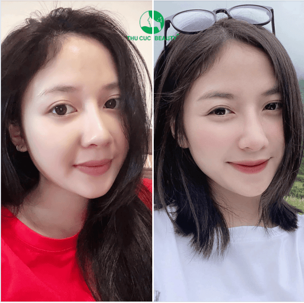 Có bao nhiêu “loại” rãnh cười và cách phân loại như thế nào?