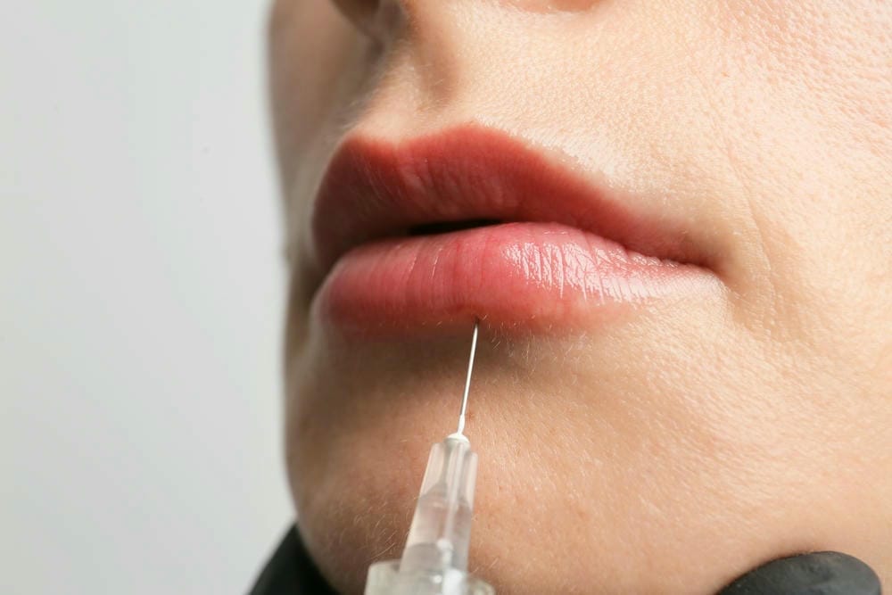 Làm sao để chọn đúng loại Stylage cho từng vùng: môi, rãnh mũi, thái dương, cằm, đầy khuôn mặt?