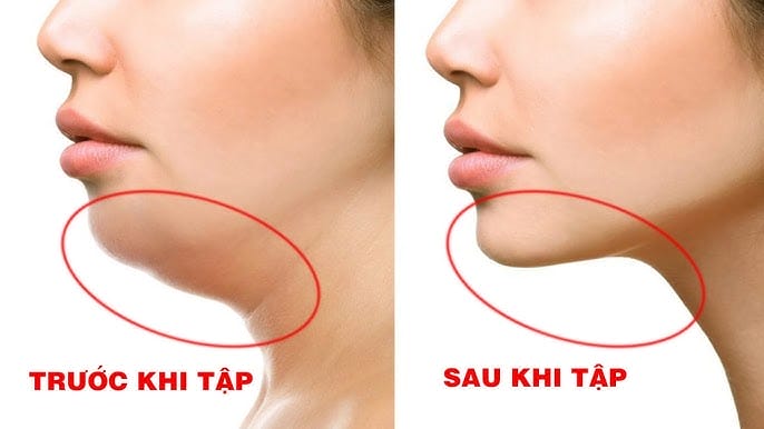 Những phương pháp giảm mỡ nọng cằm nào hiệu quả — phương pháp nào phù hợp với ai?