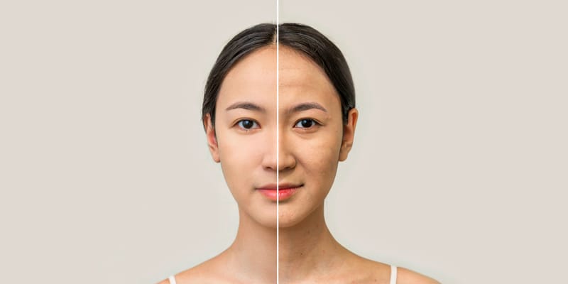 Làm sao để chọn nơi thực hiện điều trị rãnh cười an toàn và có kết quả tự nhiên?