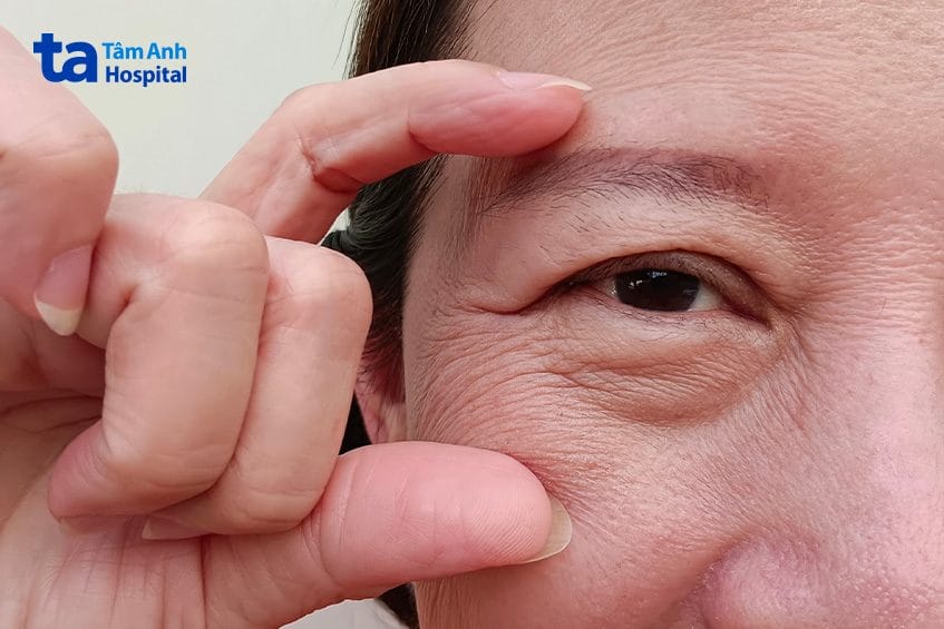 Những bước chăm sóc tại nhà nào thực sự giúp giảm nếp nhăn quanh mắt?