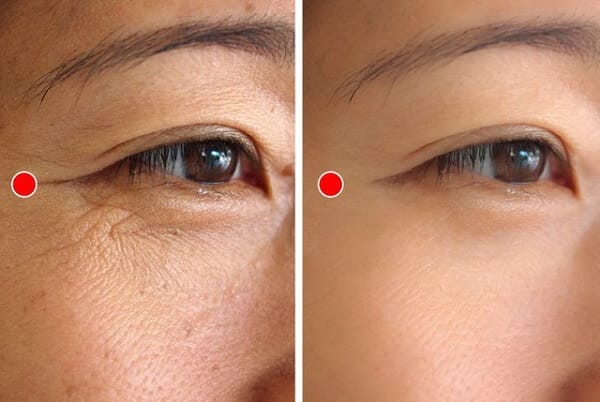 Các liệu pháp thẩm mỹ nào có hiệu quả và an toàn cho nếp nhăn quanh mắt?