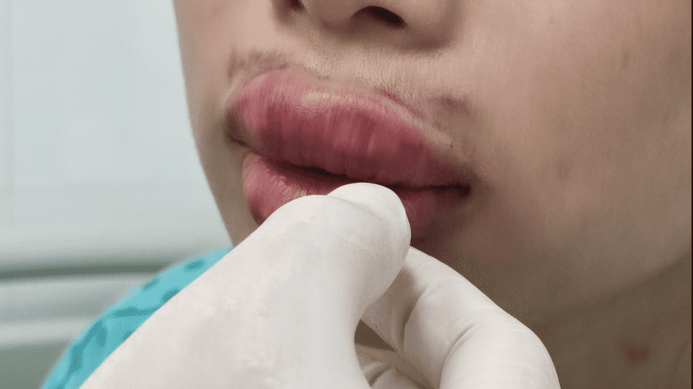 Chườm lạnh sau filler hay chườm ấm — khi nào đổi phương pháp?