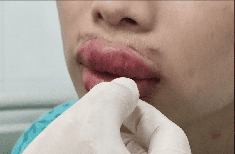 Tiêm filler môi xong nên làm gì ngay để giảm sưng — những bước chăm sóc sau tiêm filler quan trọng?