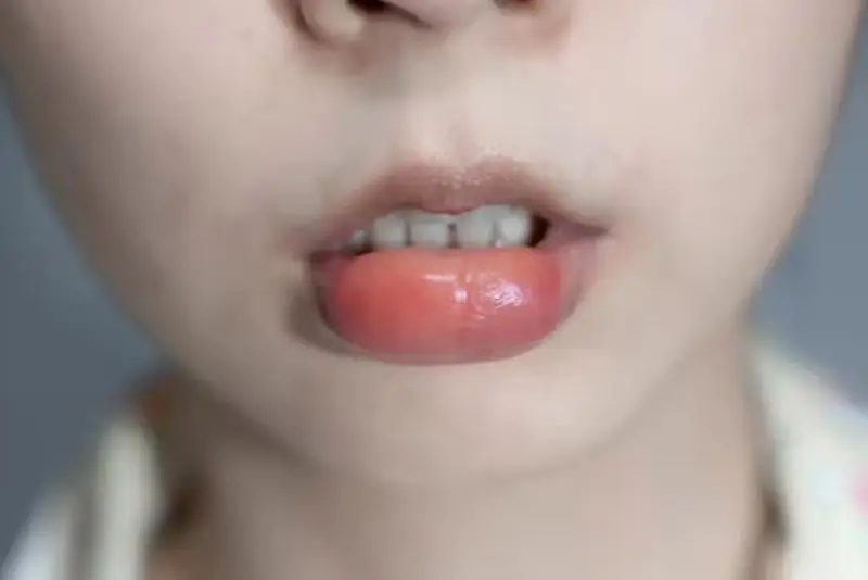 Tại sao môi lại sưng sau khi tiêm filler — đó có phải phản ứng bình thường không?