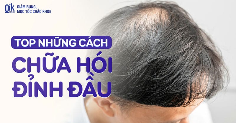 Những phương pháp y khoa: minoxidil, finasteride có bằng chứng giúp mọc tóc ở đỉnh đầu
