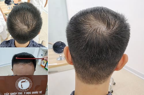 Các liệu pháp hỗ trợ và công nghệ che khuyết: PRP, LLLT, SMP — hiệu quả ra sao?