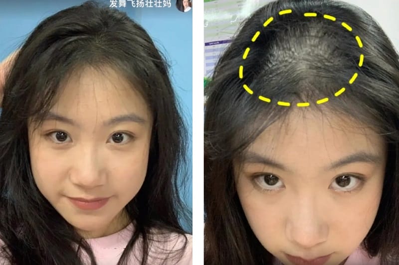 So sánh nhanh: Khi nào nên chọn thuốc, khi nào cần cấy tóc, và khi nào chỉ cần che khuyết?