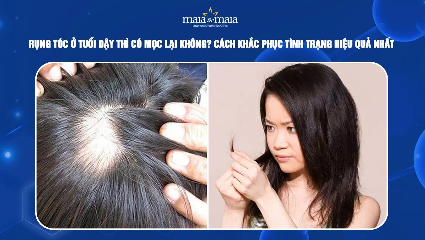 Khi nào nên dùng thuốc hoặc can thiệp y tế — và lựa chọn nào phù hợp cho tuổi dậy thì?