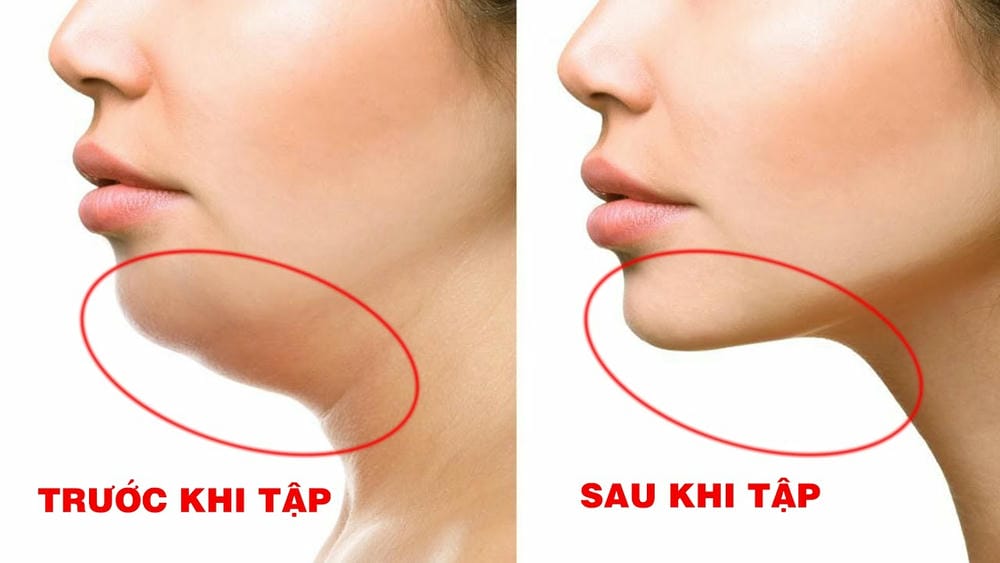 Tại sao nọng cằm xuất hiện — có phải chỉ do tăng cân?
