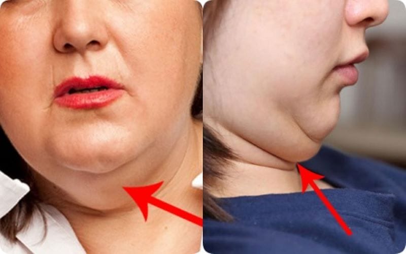 Tiêm filler và tạo đường viền hàm có giúp nọng cằm "biến mất" không?