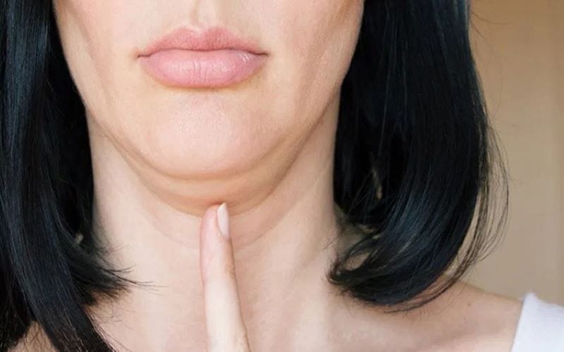 Ưu tiên phối hợp liệu pháp để giảm mỡ dưới cằm — khi nào nên kết hợp?