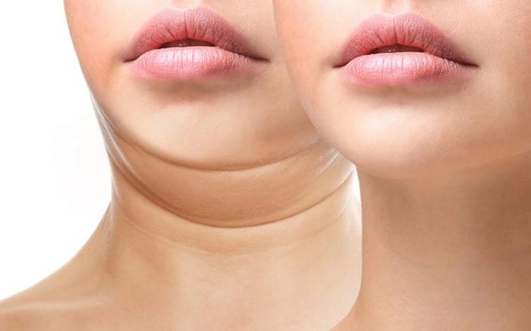 Tập tại nhà có giúp nọng cằm biến mất hoàn toàn không?