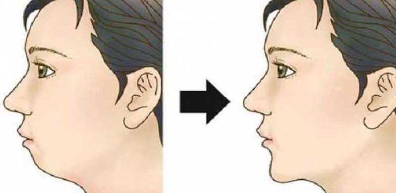 Phương pháp hỗ trợ không phẫu thuật: chỉ, botox masseter, tan mỡ