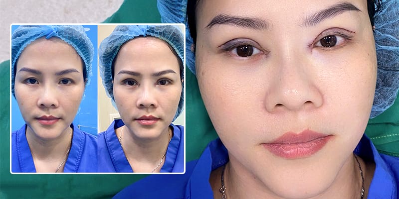 Quy trình chuẩn an toàn cho tiêm filler hốc mắt diễn ra thế nào?