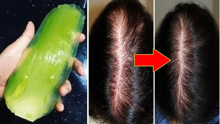 Tại sao đầu lại hói và tóc khó mọc trở lại?