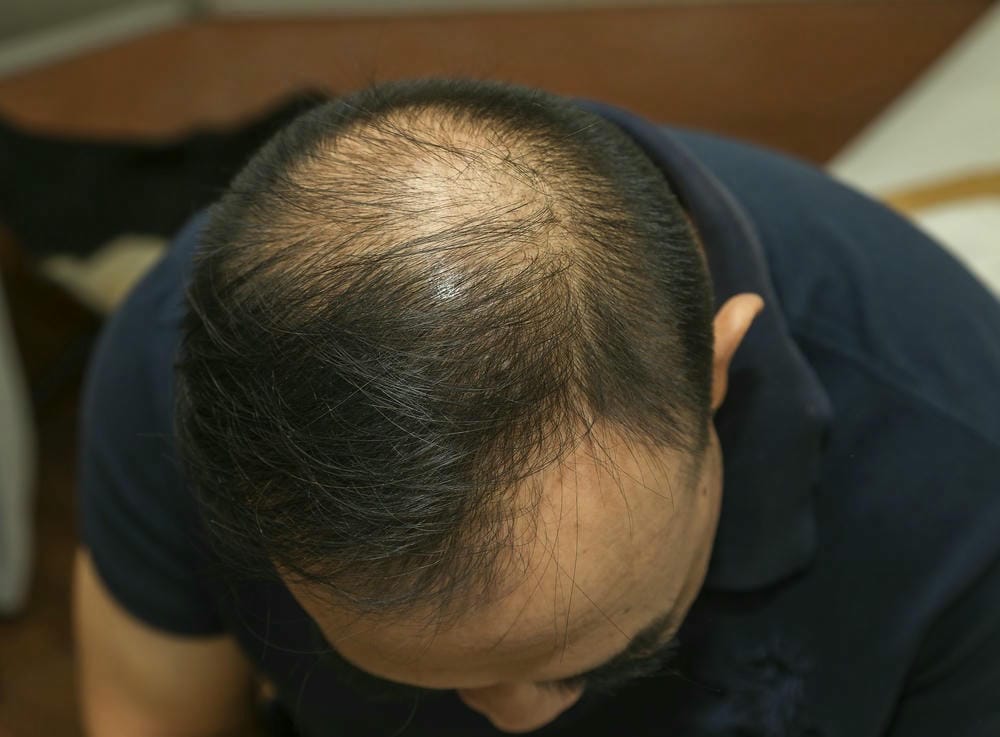Những phương pháp nào thực sự giúp tóc mọc: minoxidil 5%, finasteride 1 mg và bằng chứng nói gì?