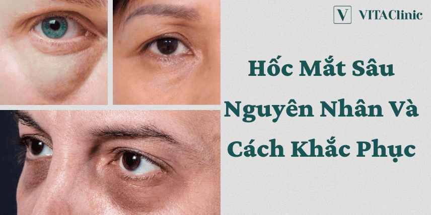 Hốc mắt sâu do đâu và cơ chế khiến vùng mắt trông hõm hơn?