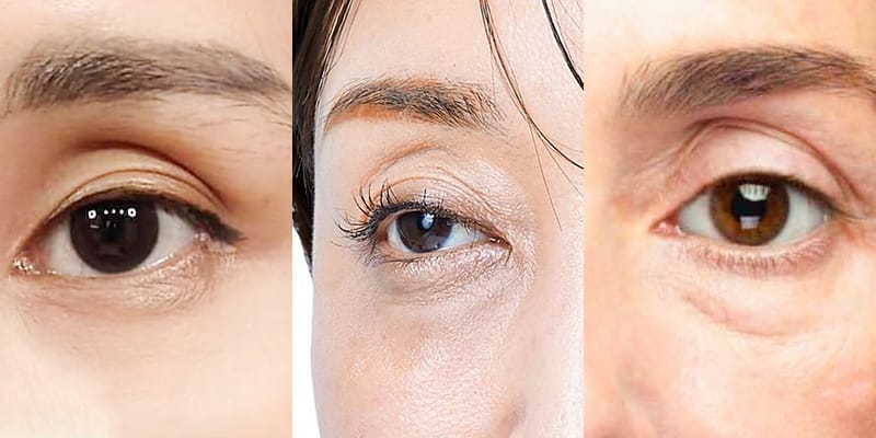 Tiêm filler, cấy mỡ, hay phẫu thuật — phương pháp nào phù hợp với hốc mắt sâu của bạn?