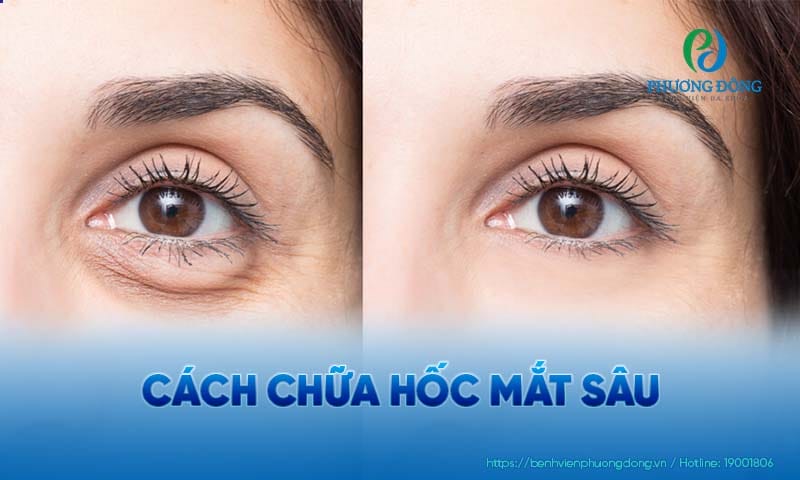 Cấy mỡ tự thân (fat grafting / fat repositioning) có lợi gì?