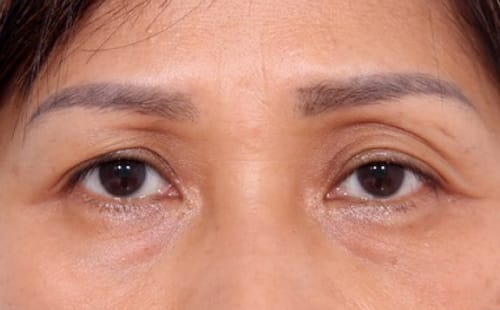 Quy trình điều trị hốc mắt sâu tại clinic: từng bước cần lưu ý như thế nào?